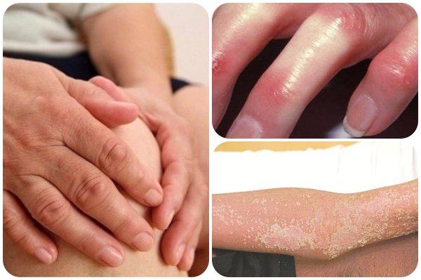 Xơ cứng bì toàn thể - Hình ảnh minh họa